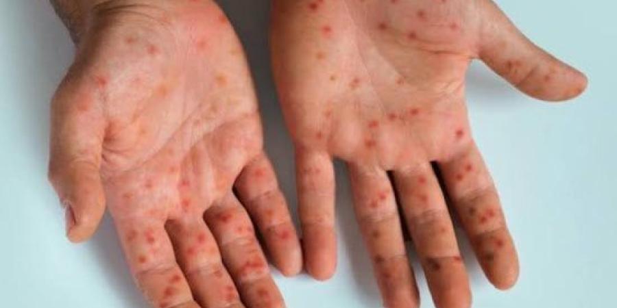 وزارة الصحة تبدأ حملة تطعيم مجانية ضد الحصبة من 9 أشهر إلى 10 سنوات